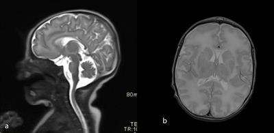 Case report: Pneumocystis jirovecii pneumonia in a severe case of Aicardi–Goutières syndrome with an IFIH1 gain-of-function mutation mimicking combined immunodeficiency